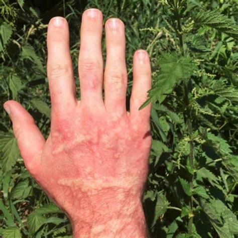 You will often find patches of <b>stinging</b> <b>nettle</b> in damp and moist areas, especially near streams, or in wooded areas with a thick canopy. . Stinging nettle florida rash